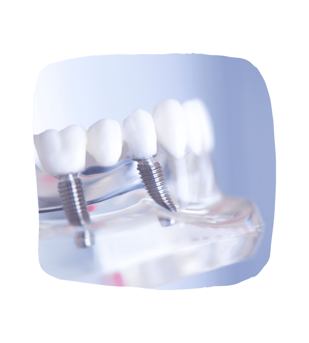Dental Implant