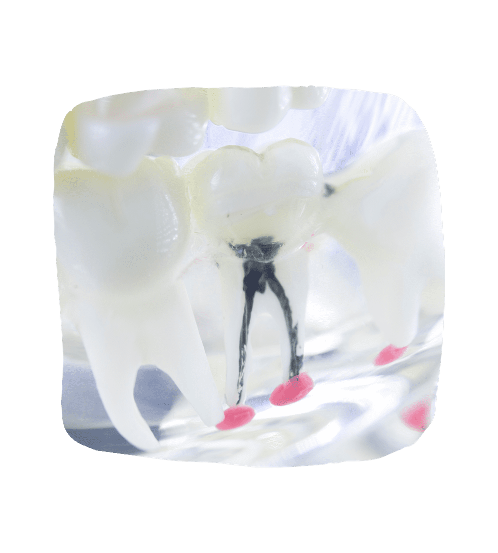 Root Canals Dental Faith Nashville Dentistry