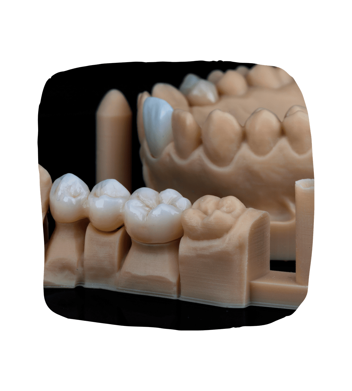 Dental Bridges Dental Faith Nashville Dentistry