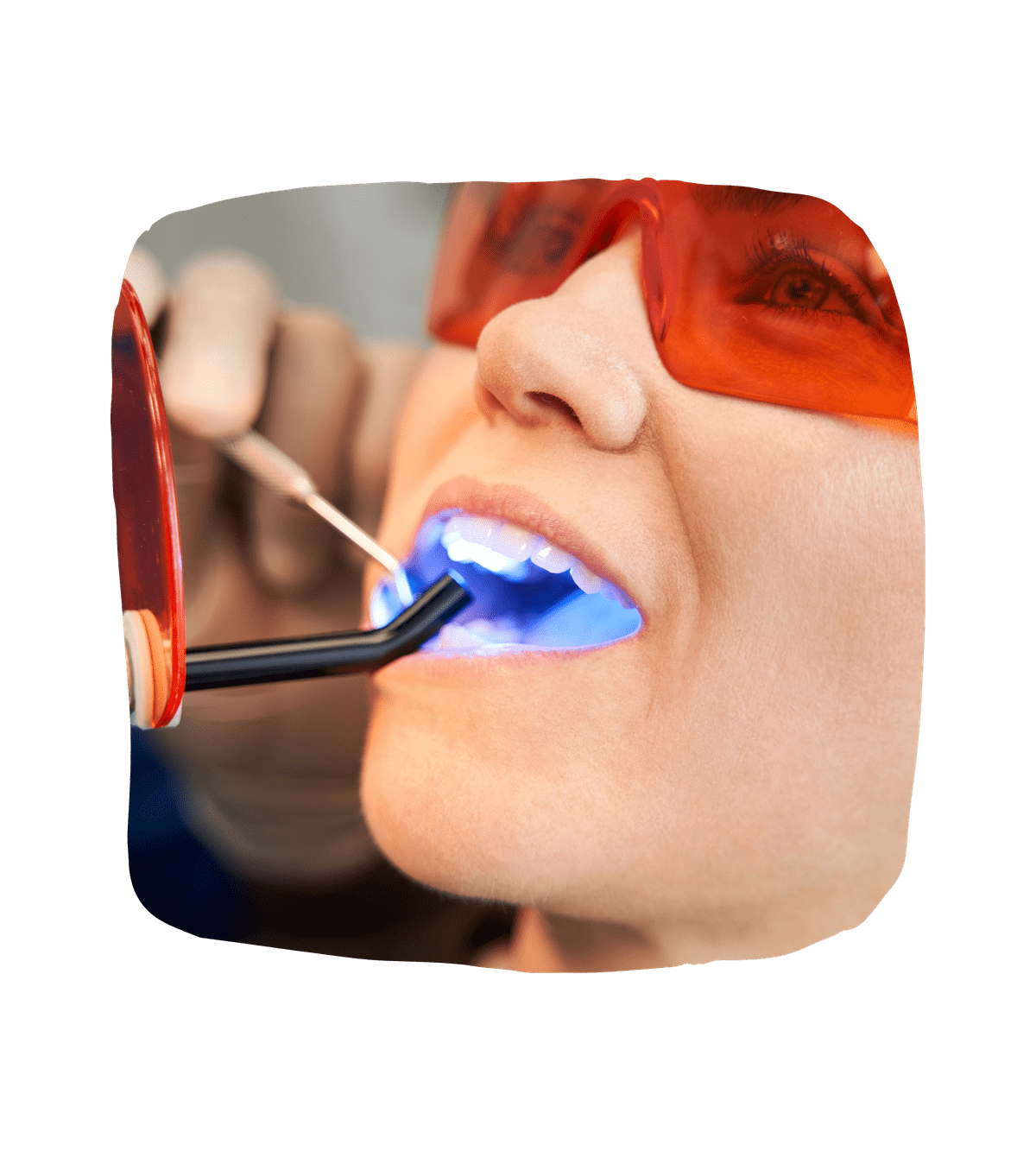Dental Fillings