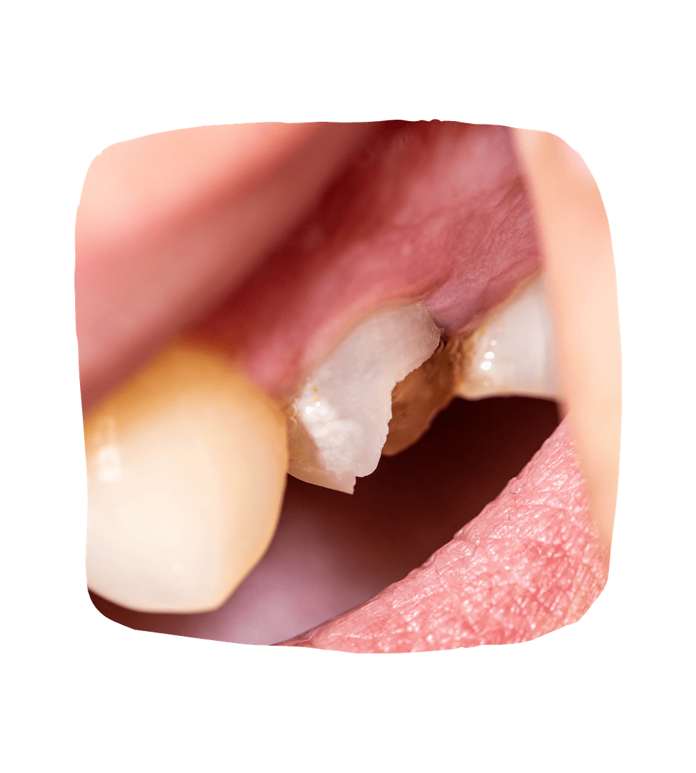 Broken tooth photo - fix a chipped tooth at the gum line