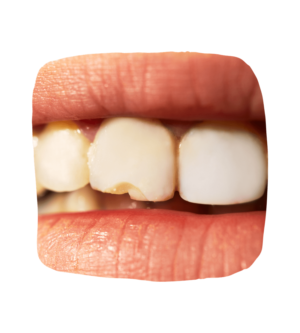 Emergency Dentistry Solutions for a Cracked Tooth Dental Faith