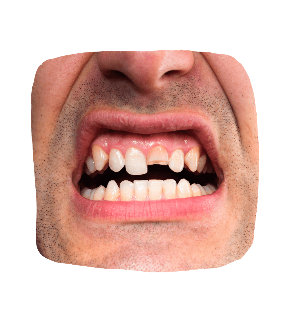 Cracked Tooth in Nashville