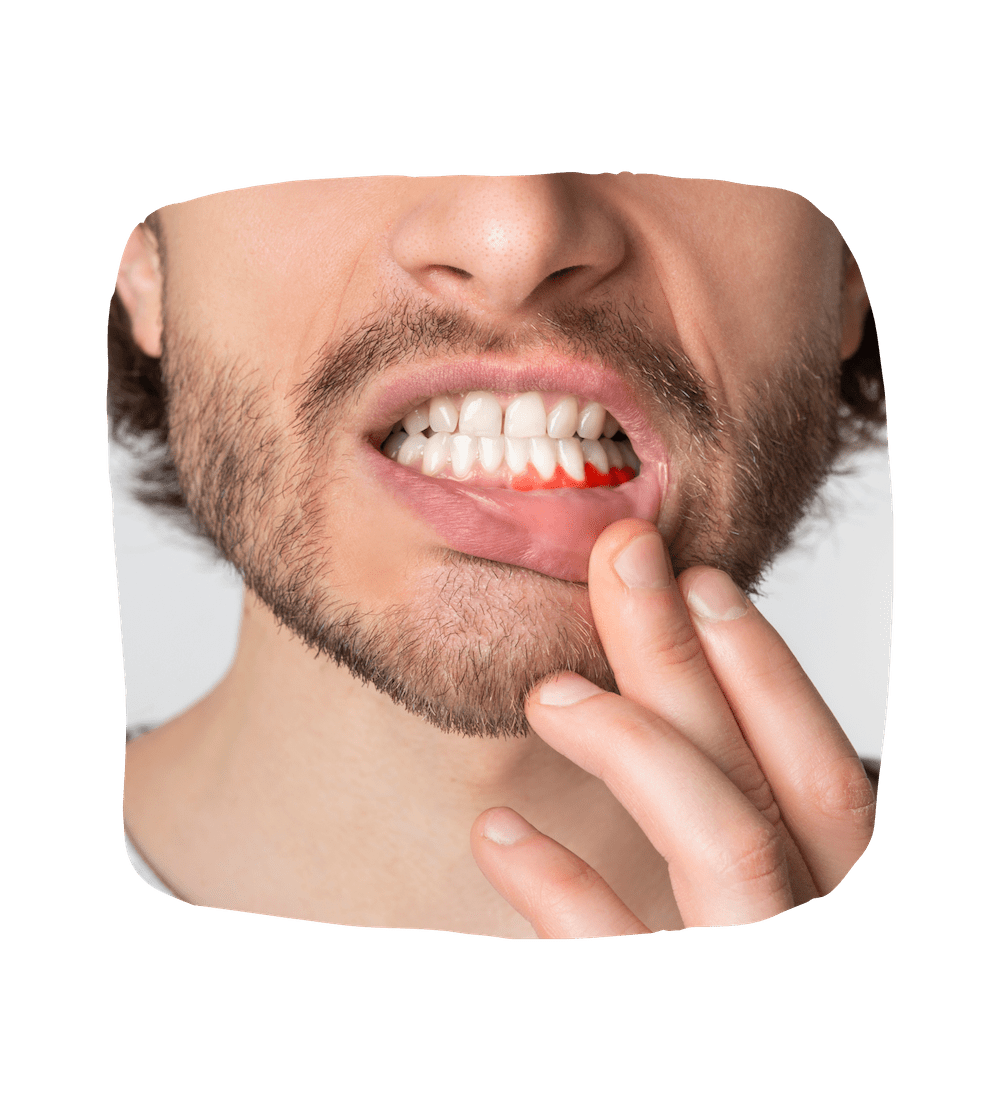 Gum Bleeding photo