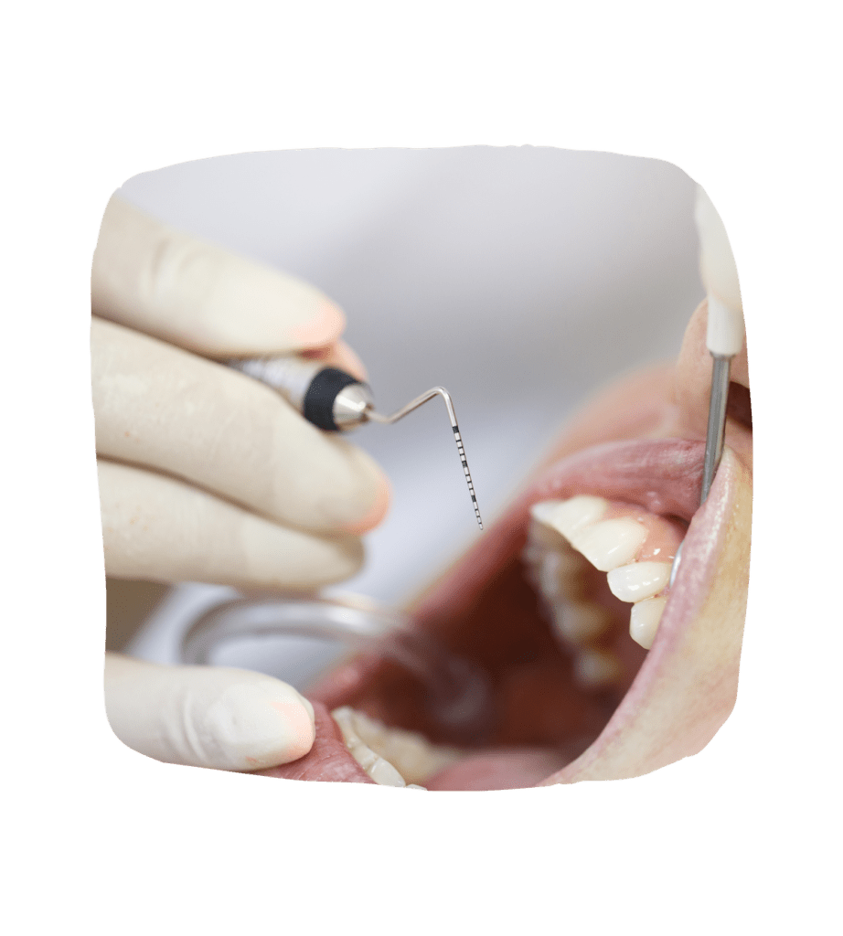 Periodontal-Therapy-dental