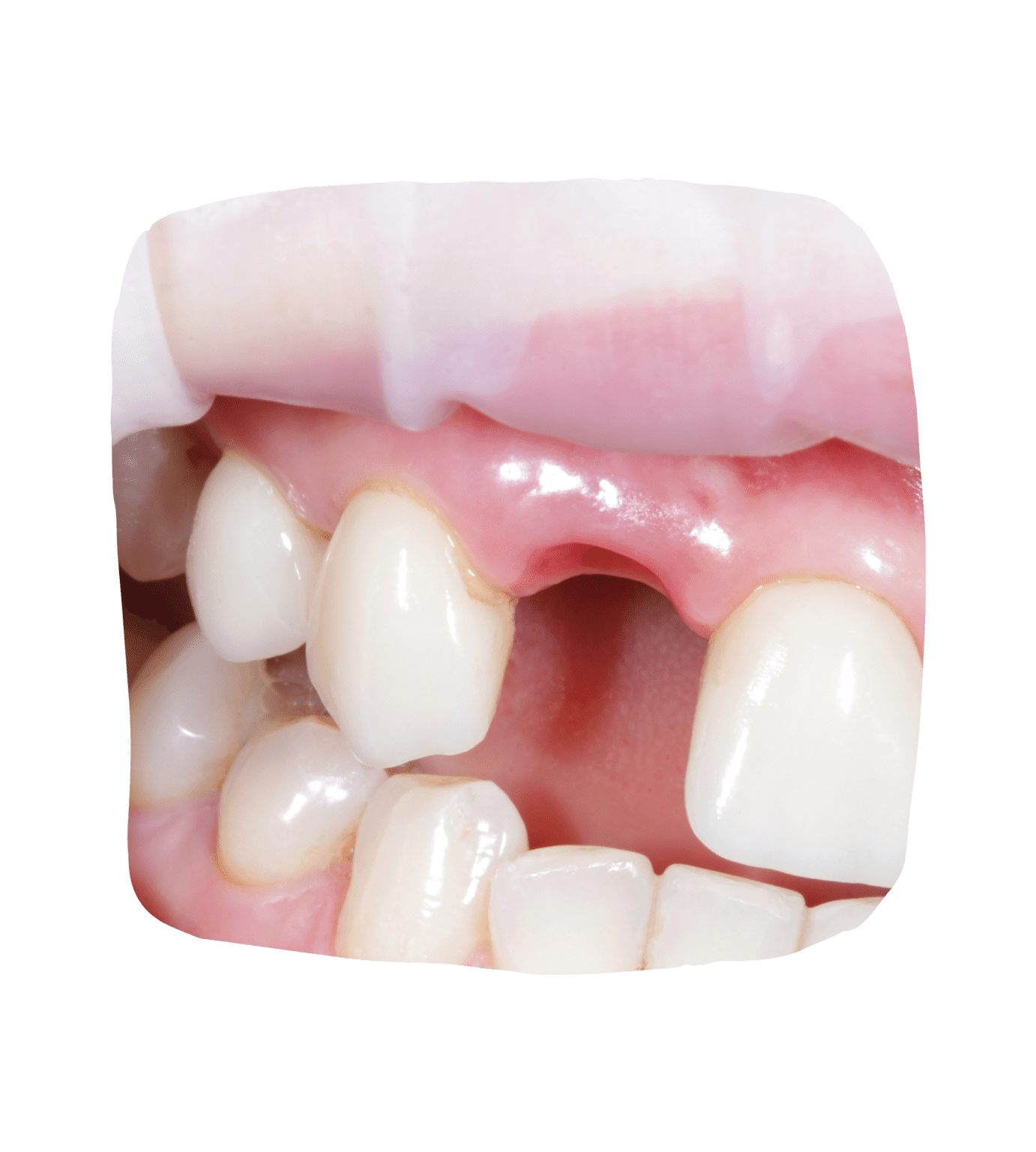 Professional Dental Extraction Services Dental Faith