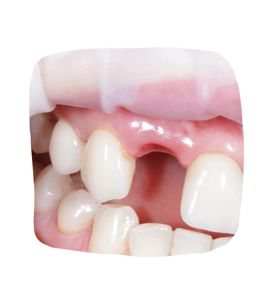 Foto de extracciones dentales.