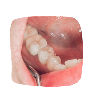 Dental Crowns in Nashville