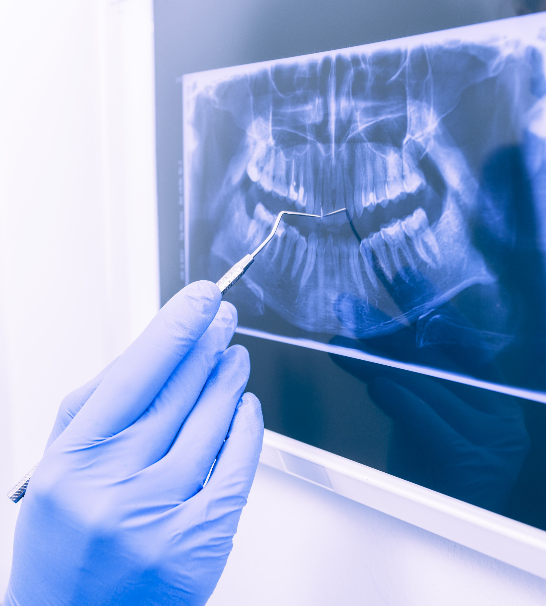 Dental X-rays importance blog for dental faith