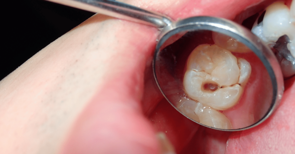 how can i make my tooth extraction heal faster naturally