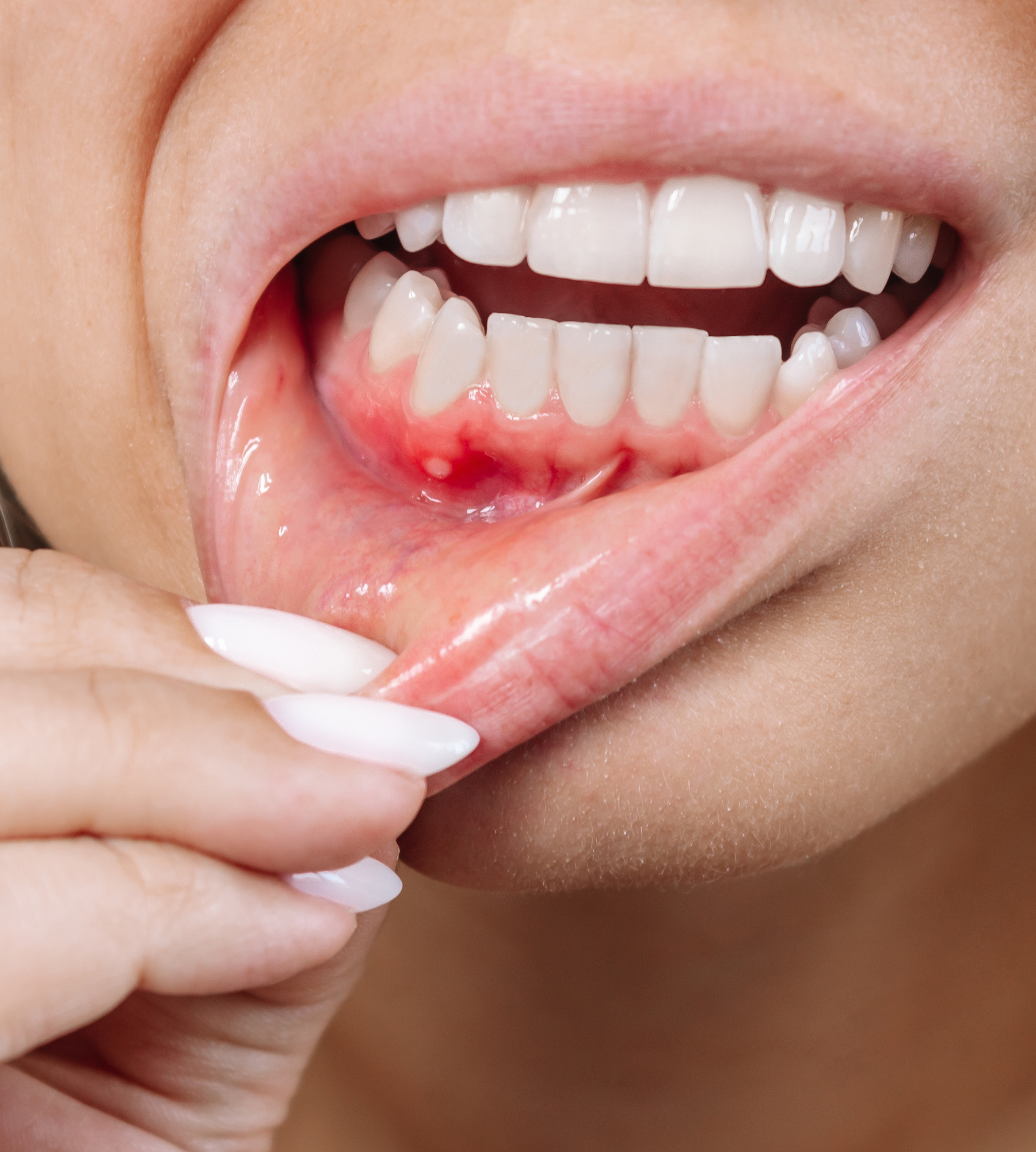 5 Natural Ways to Cure Gum Disease Without a Dentist in Nashville, TN