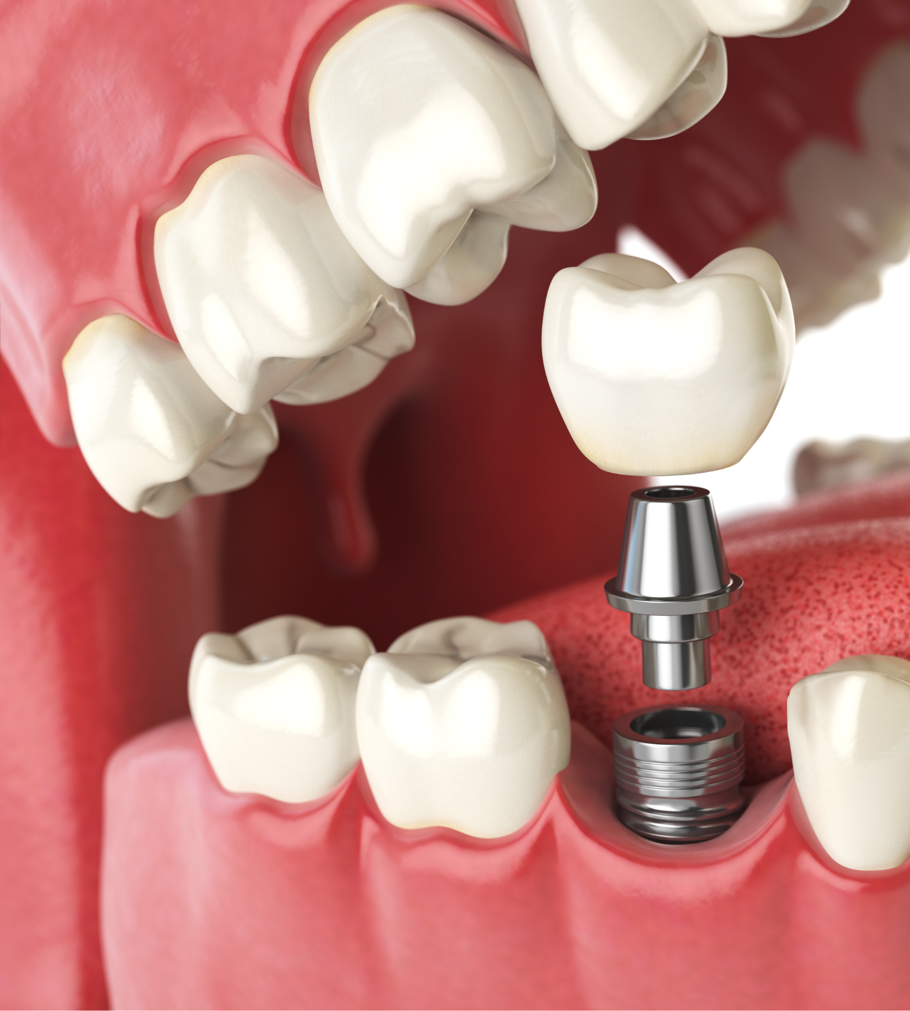 affordable dental implants blog