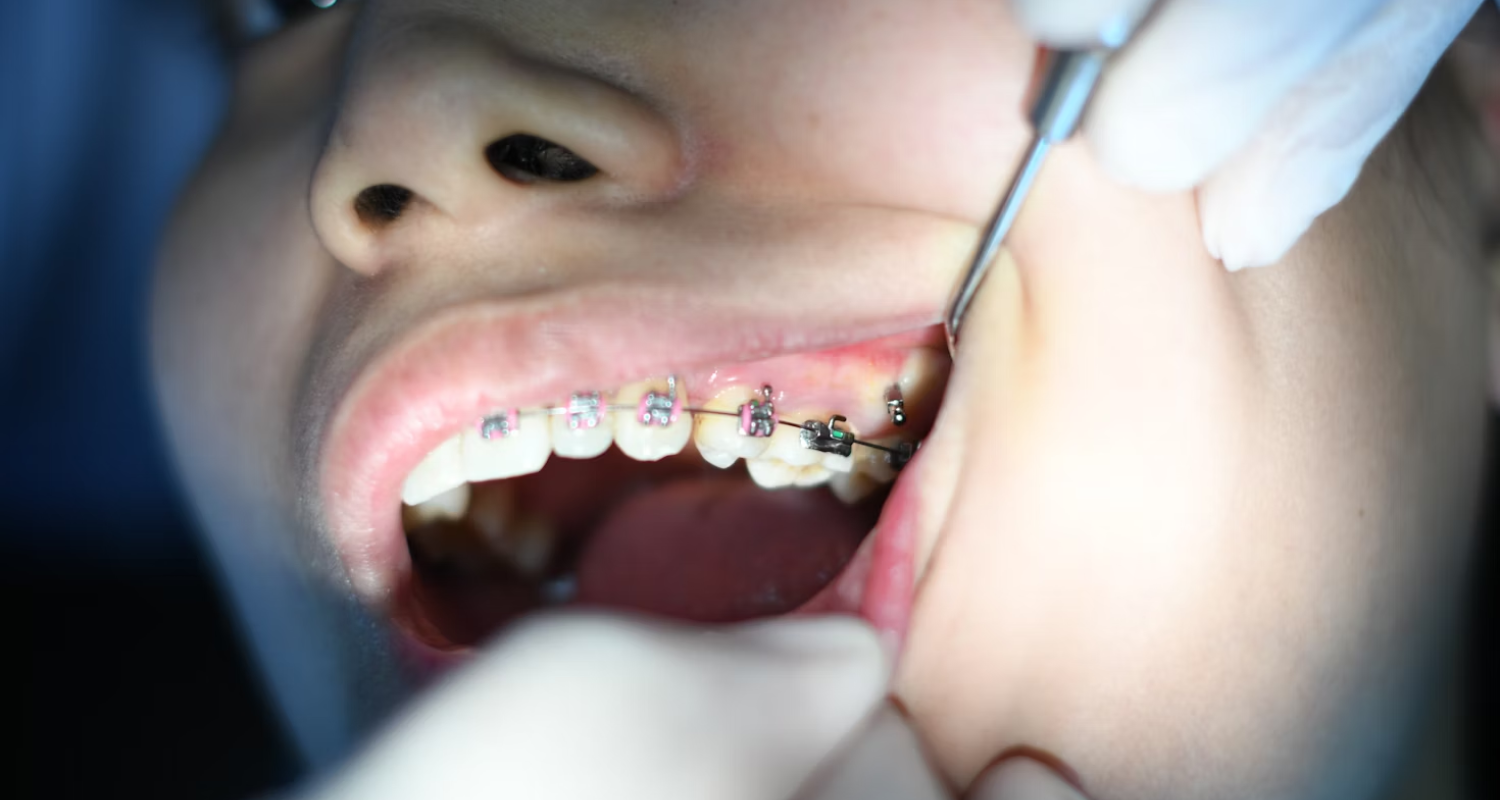 How Much Is It To Get A Tooth Capped