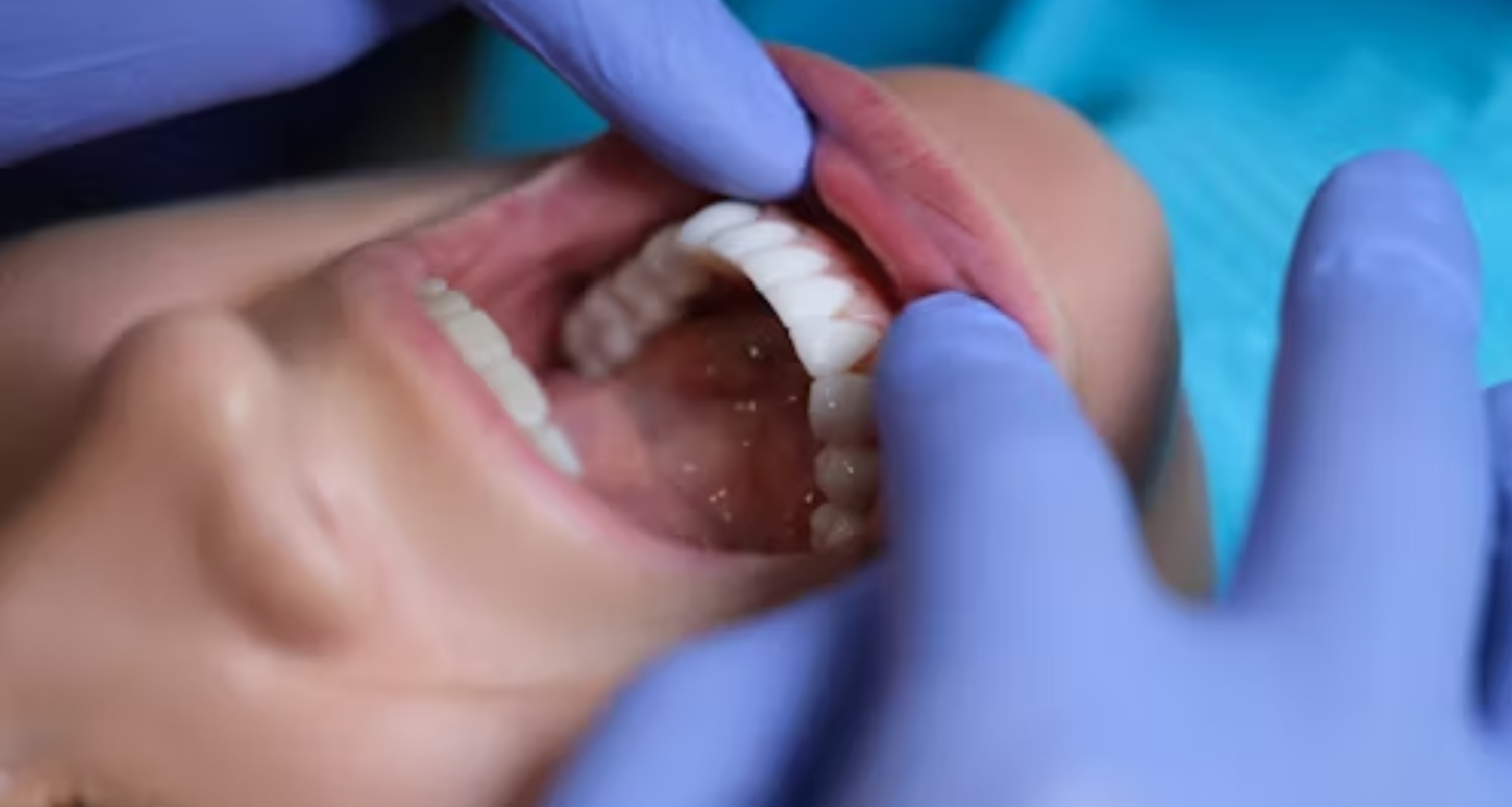 What Type of Dentist Does Root Canals