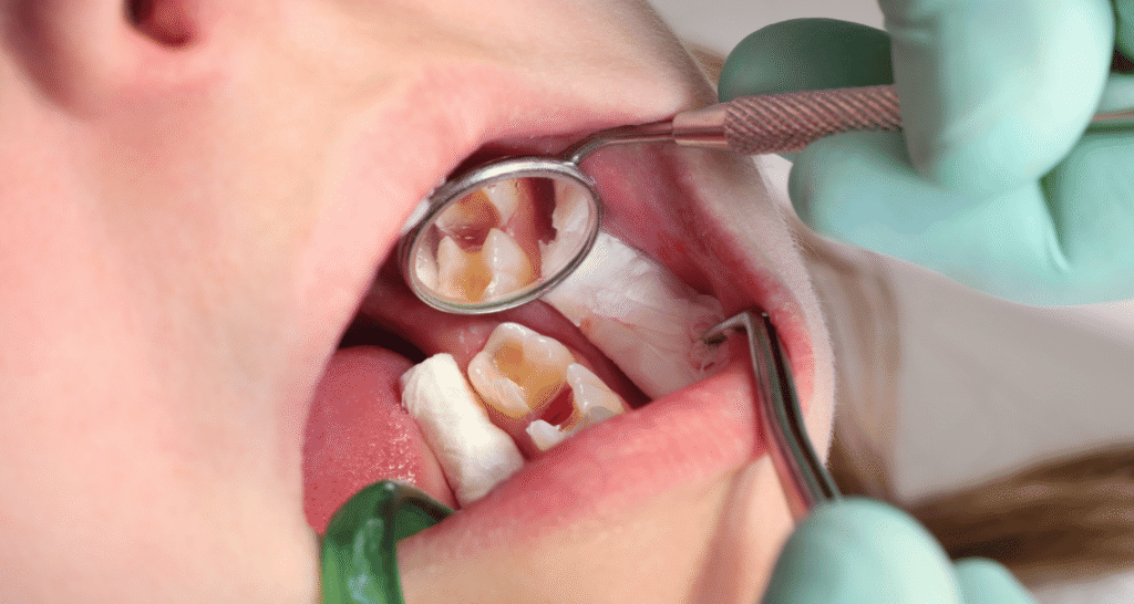 Ways to Prevent Cavities in Your Child
