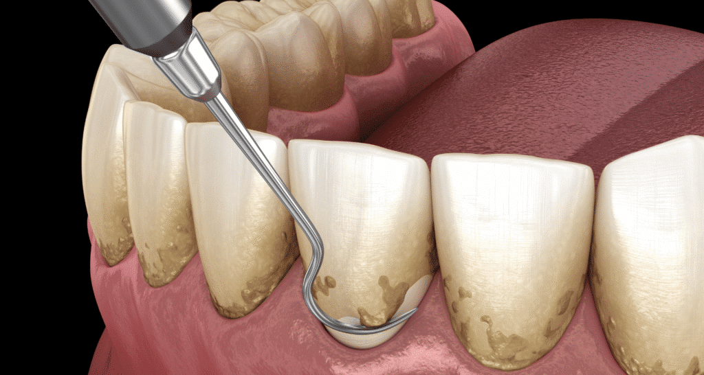 Advanced periodontitis treatment