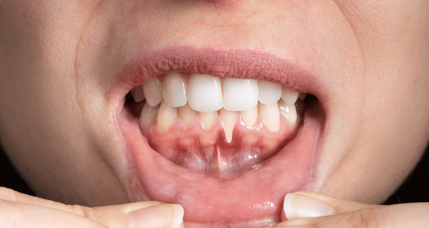 How long can you keep your teeth with periodontal disease