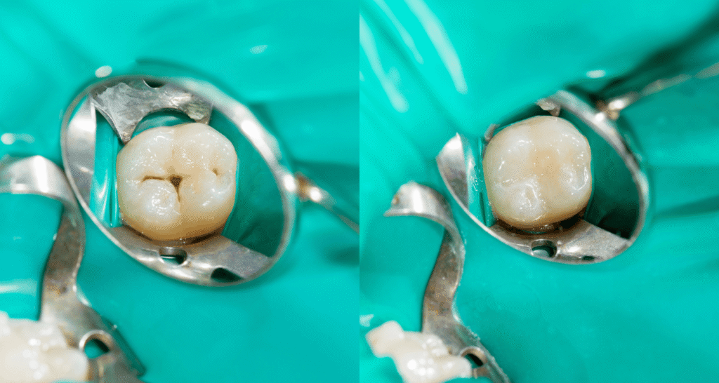 dental sealant vs filling