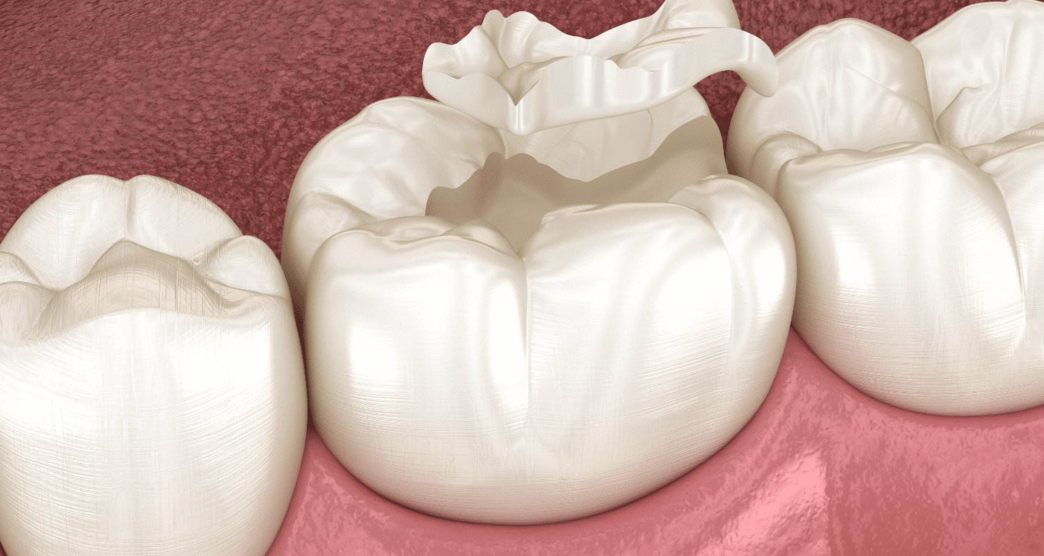 dental sealant vs filling