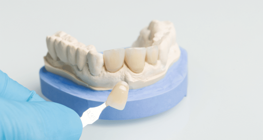 tooth crown vs veneer