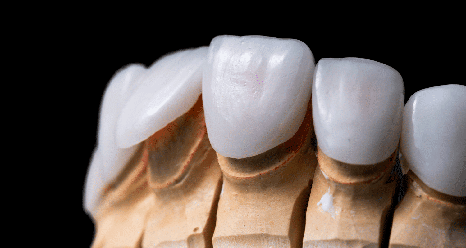 tooth crown vs veneer