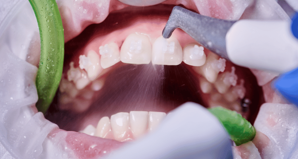 Benefits of Regular Dental Cleanings in Nashville