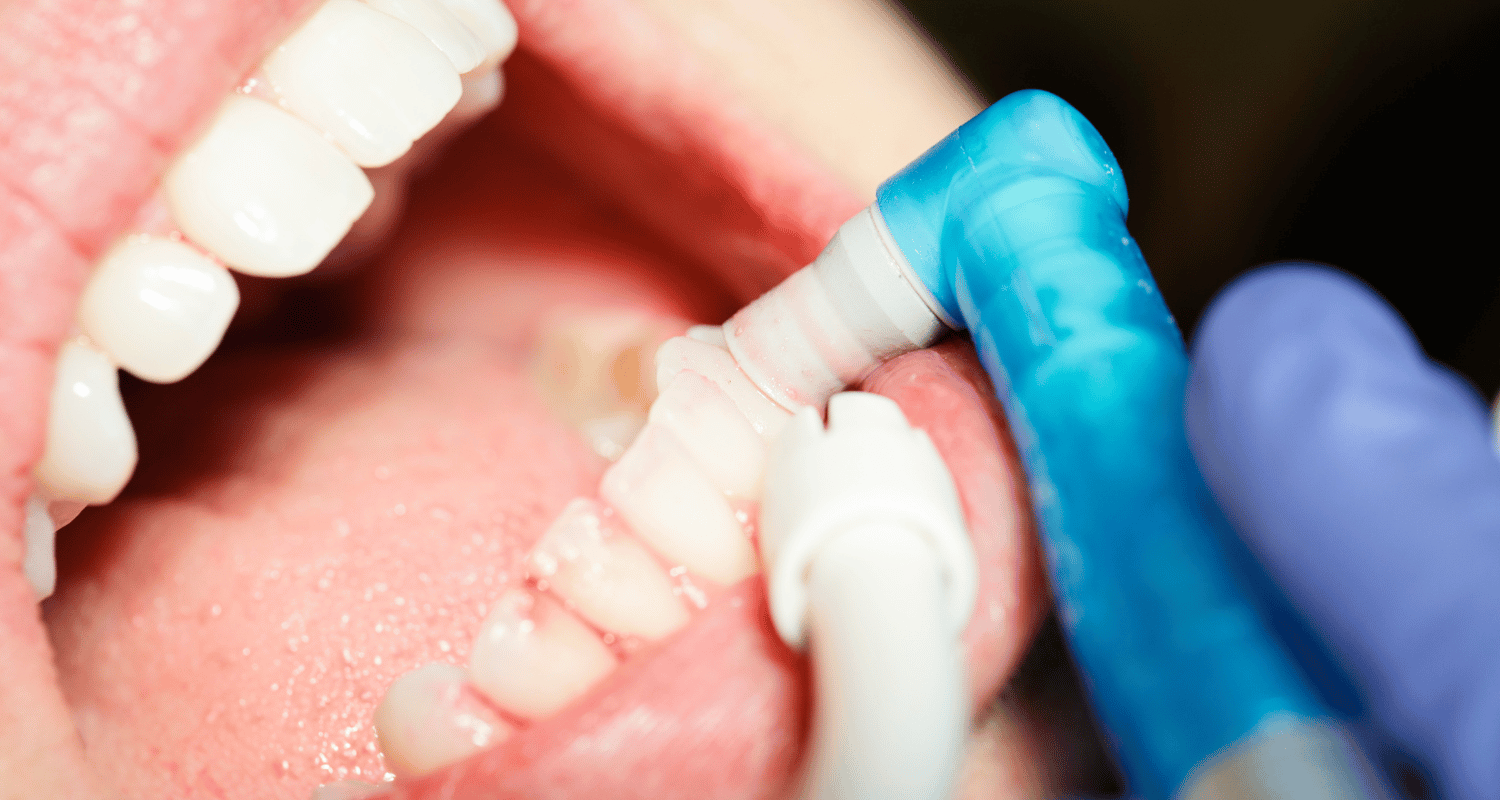Benefits of Regular Dental Cleanings in Nashville