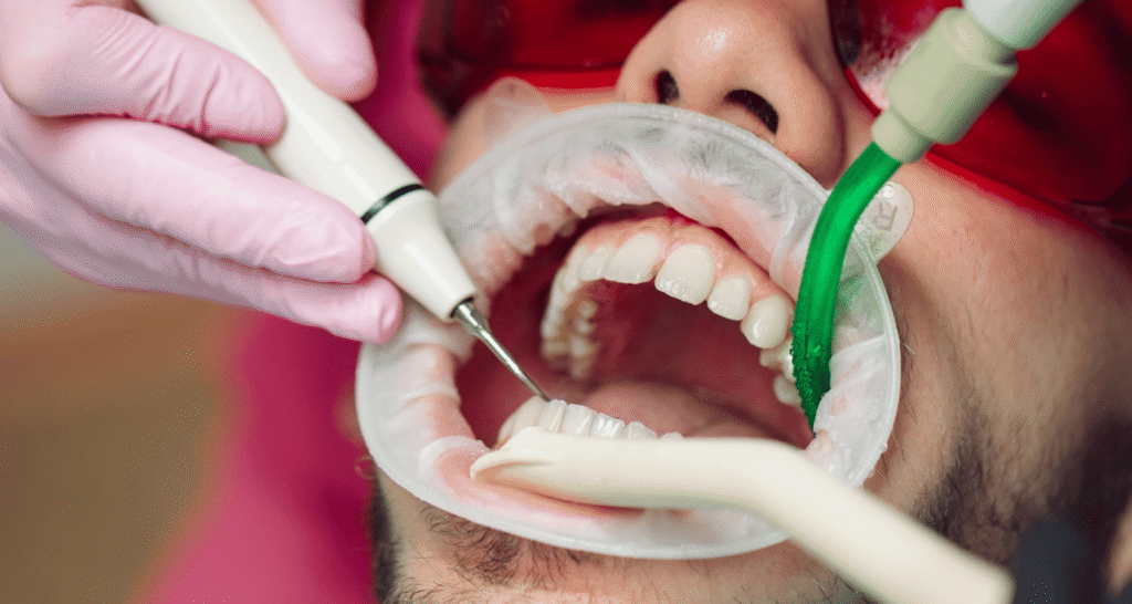 Dentist Scaling vs Cleaning
