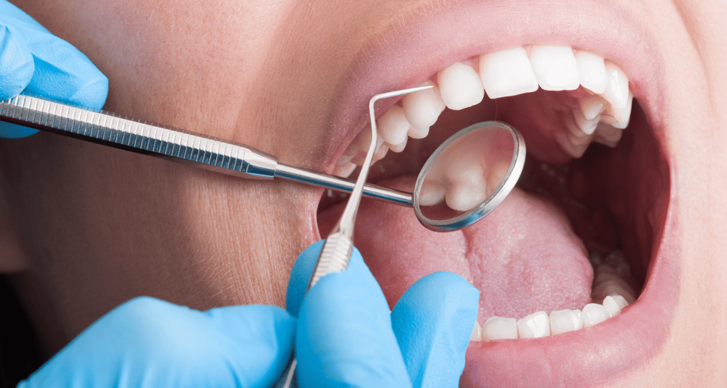 Dentist Scaling vs Cleaning