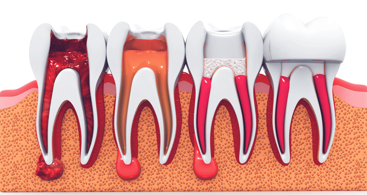 How Long Is a Root Canal Recovery?