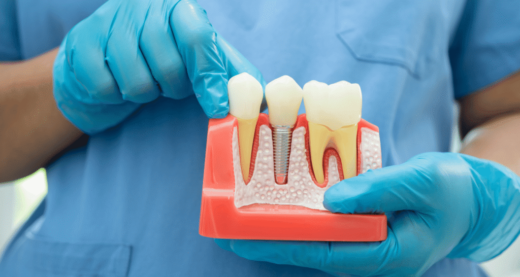 How Long Is a Root Canal Recovery