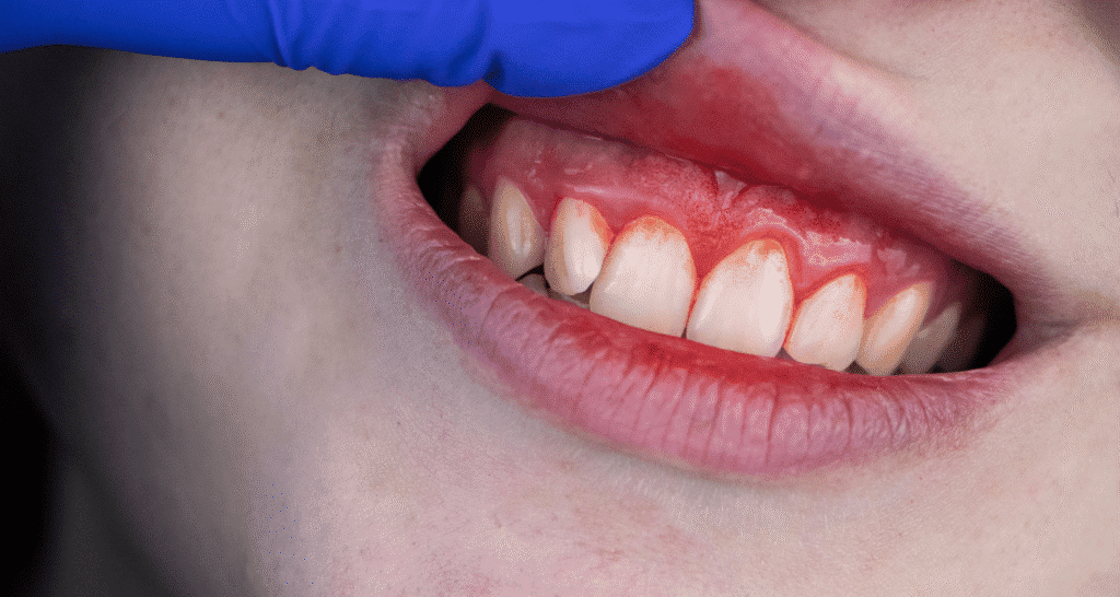How to Know If You Have Gingivitis