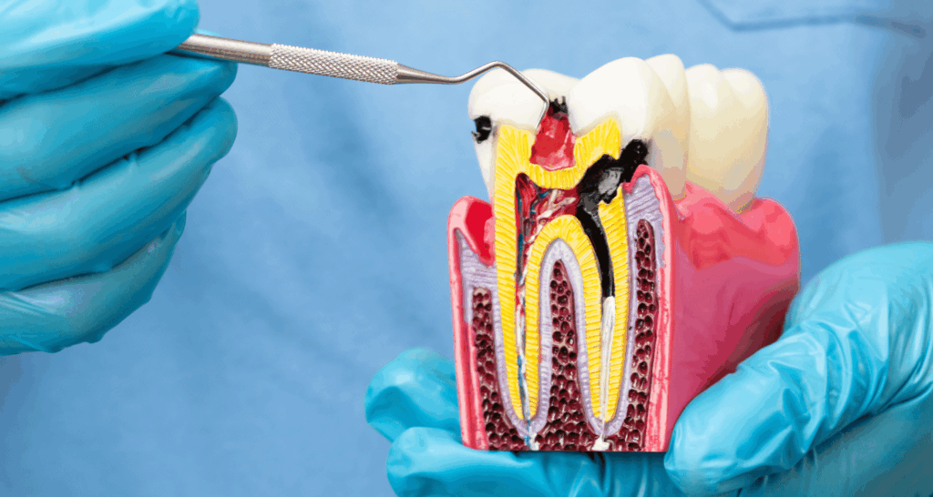Root Canal vs Dental Implant: How to Choose What's Right for You 1 root canal vs implant
