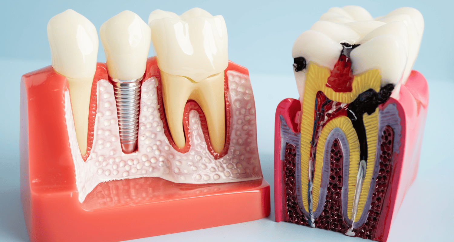 Root Canal vs Crown