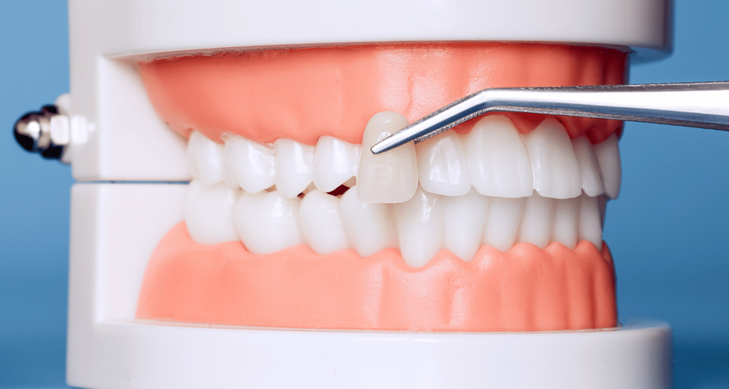 Can You Get Dental Implants With Gum Disease