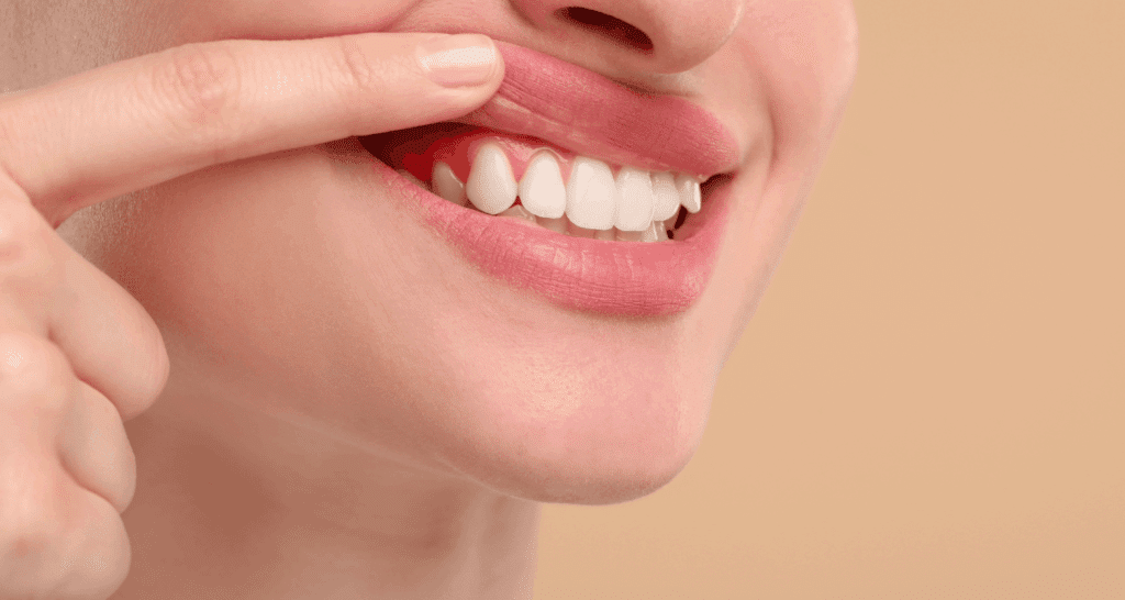 How to Cure Gum Disease Without a Dentist 1 How to Cure Gum Disease Without a Dentist