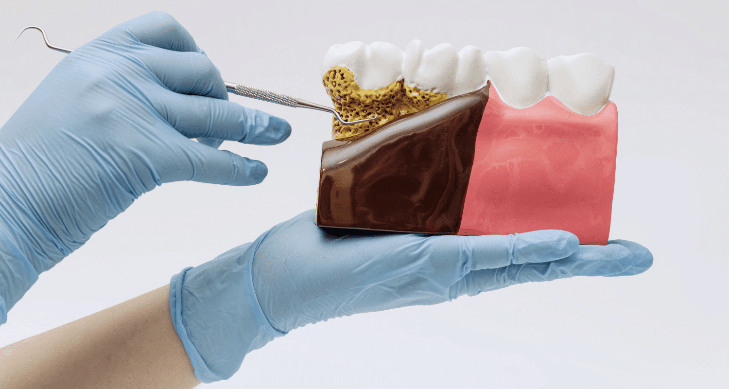 How to Cure Gum Disease Without a Dentist