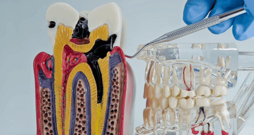 How Long Does a Root Canal Take? 1 How Long Does a Root Canal Take