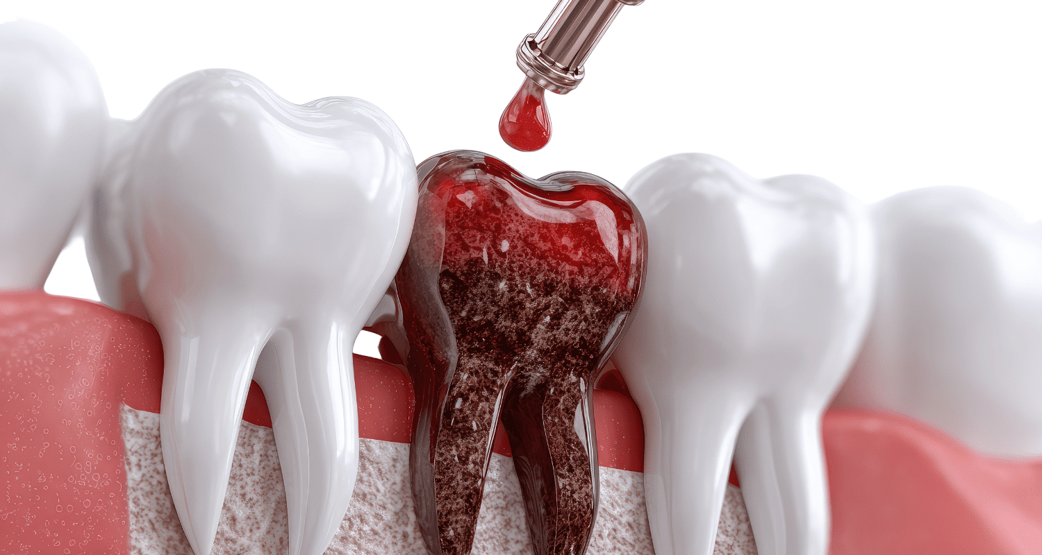 How Long Does a Root Canal Take