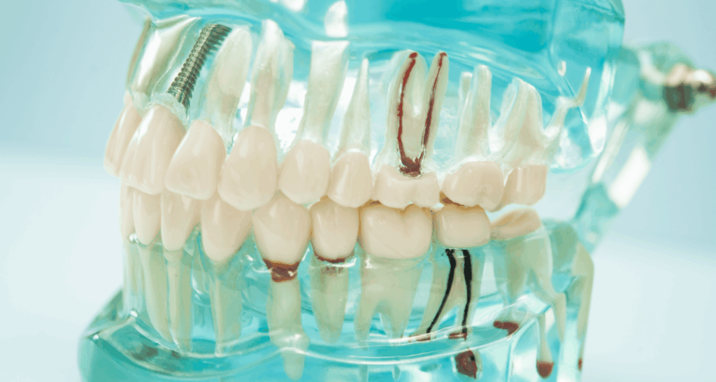 Root Canal Retreatment: Causes, Procedure, Success Rate & Cost 1 root canal retreatment