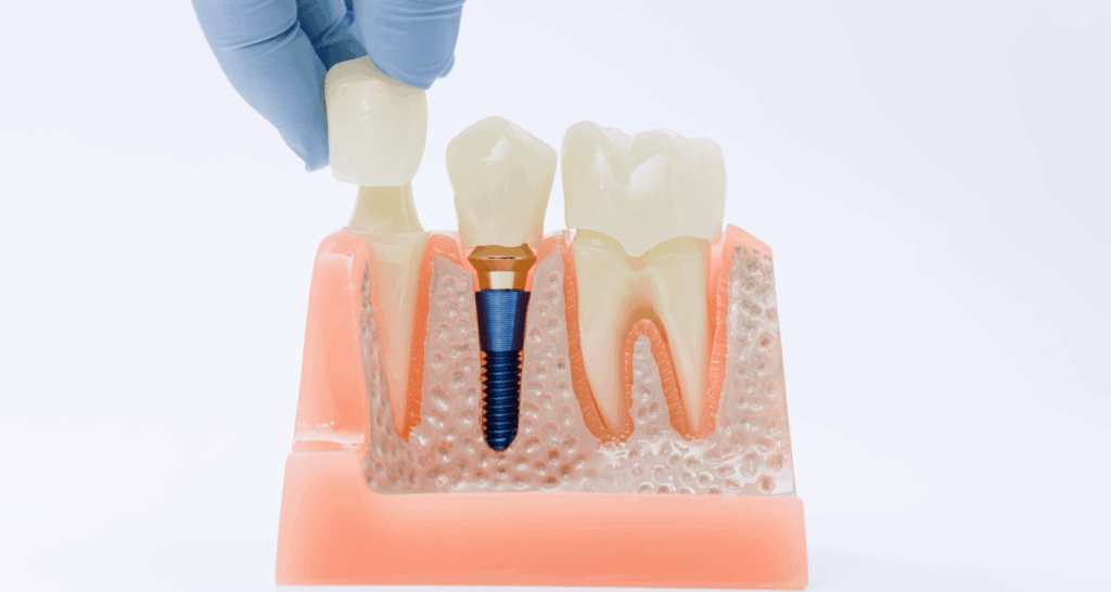 Reasons Why You Should Consider Dental Crowns in Nashville 1 5 Reasons Why You Should Consider Dental Crowns in Nashville