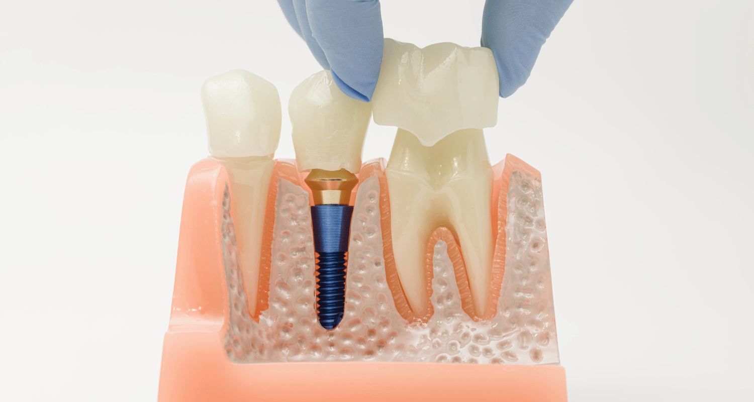 5 Reasons Why You Should Consider Dental Crowns in Nashville