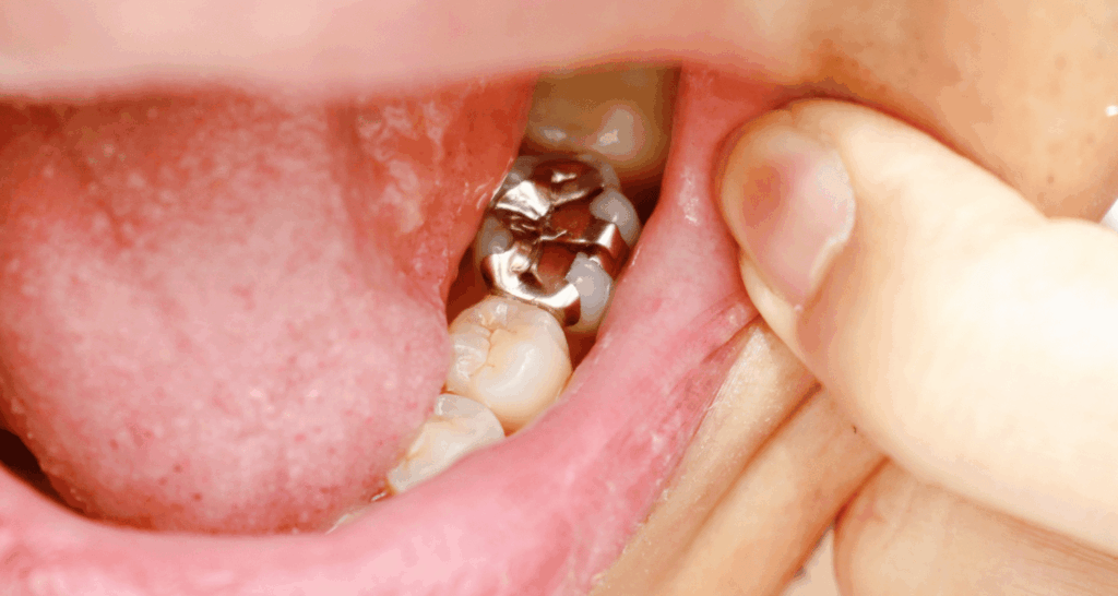 What Patients Should Know Before a Dental Filling Procedure