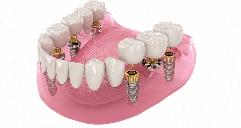 What Are the Problems With All-on-4 Dental Implants