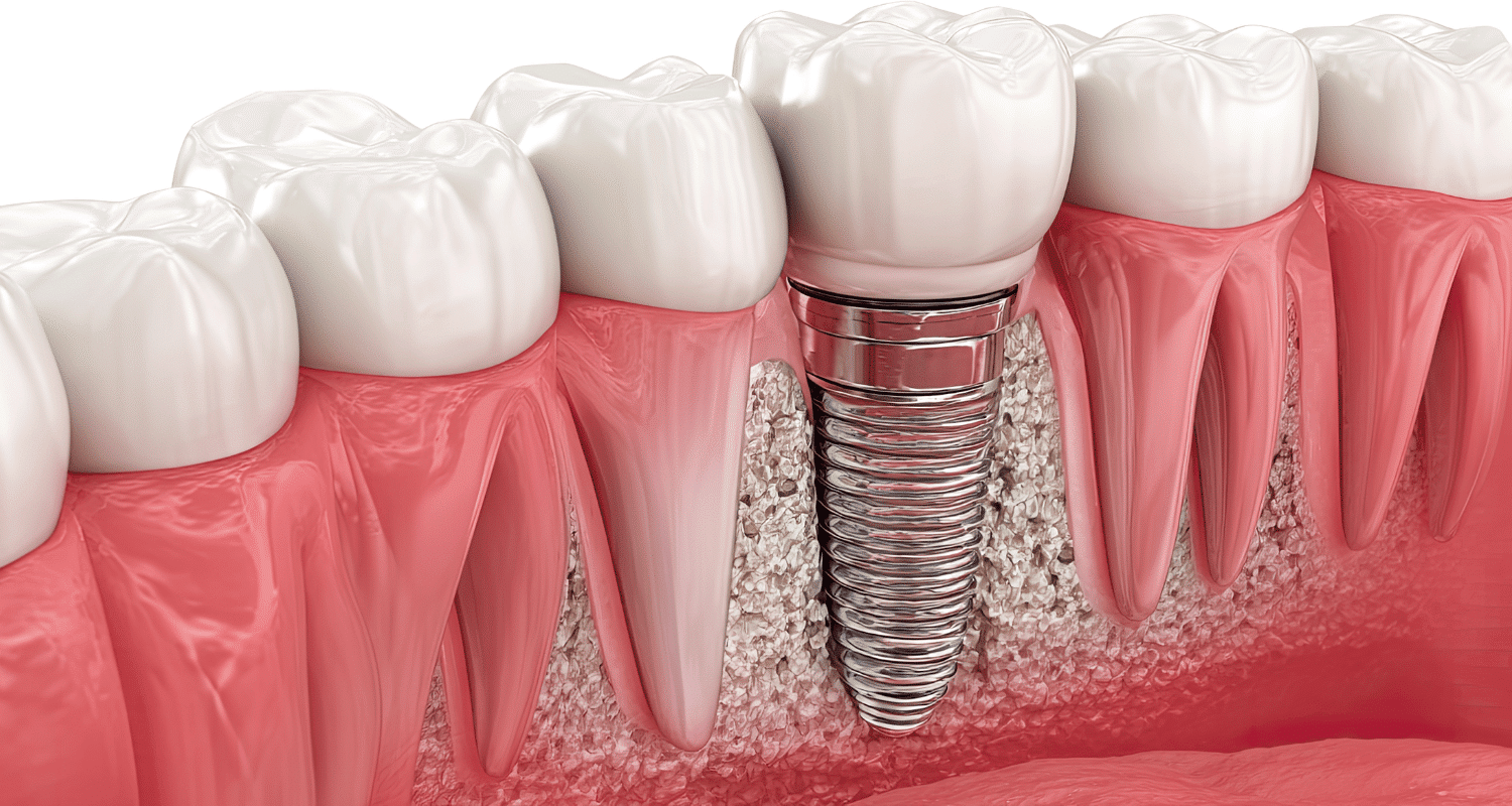 ¿Cuáles son los problemas de los implantes dentales All-on-4?