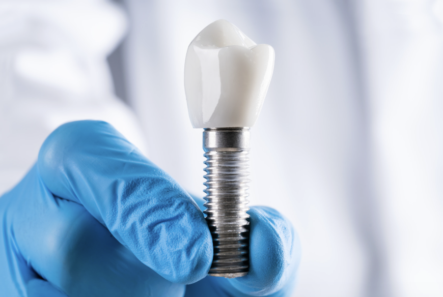 Dental Implants for Seniors Benefits, Costs, Risks & Everything You Need to Know