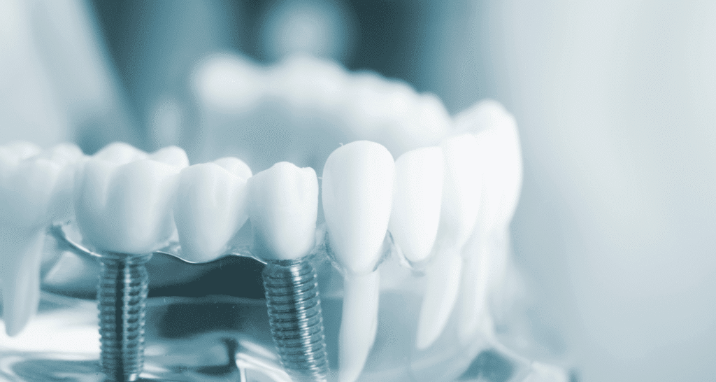 Dental Implants for Seniors: Benefits, Costs, Risks & Everything You Need to Know 1 Dental Implants for Seniors_ Everything You Need to Know