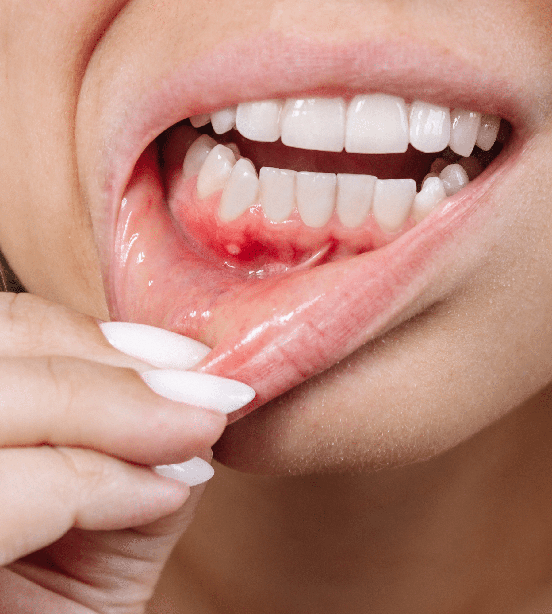 5 Natural Ways to Cure Gum Disease Without a Dentist in Nashville, TN