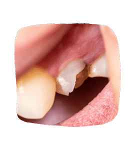 Broken tooth photo - fix a chipped tooth at the gum line