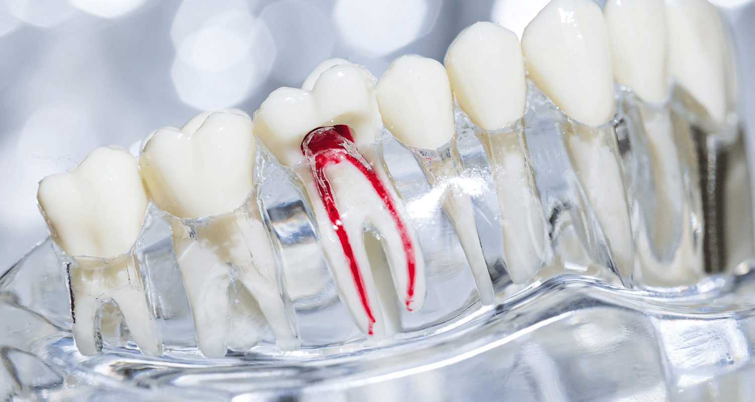 How to avoid root canal naturally
